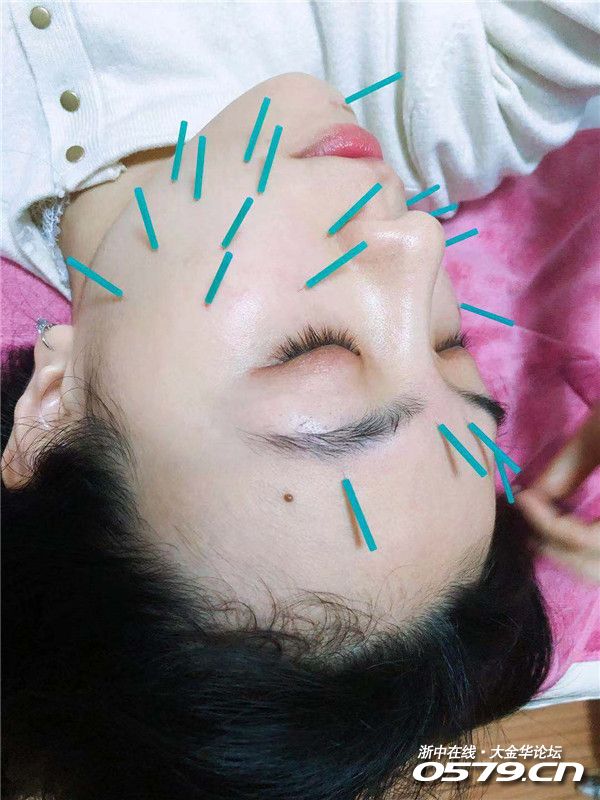 面部针灸可以改善痘痘,色素沉着,皮肤油腻,皱纹松弛,长斑等等,从而