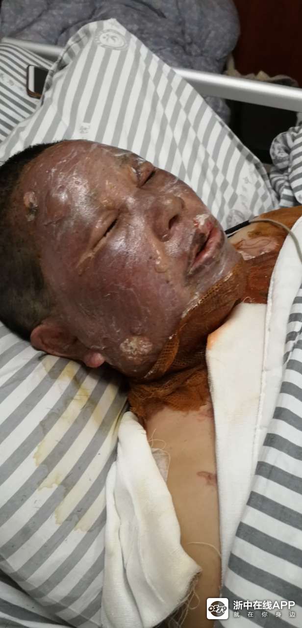 紧急求救!煤气泄漏导致3人严重烧伤,大家帮帮忙吧!