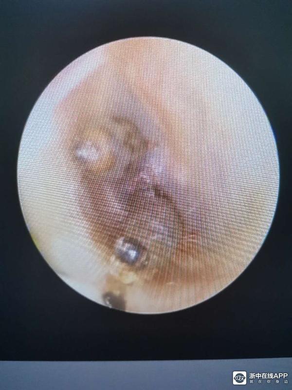 天呐!种个菜耳朵里竟然跑进这么大一个虫!